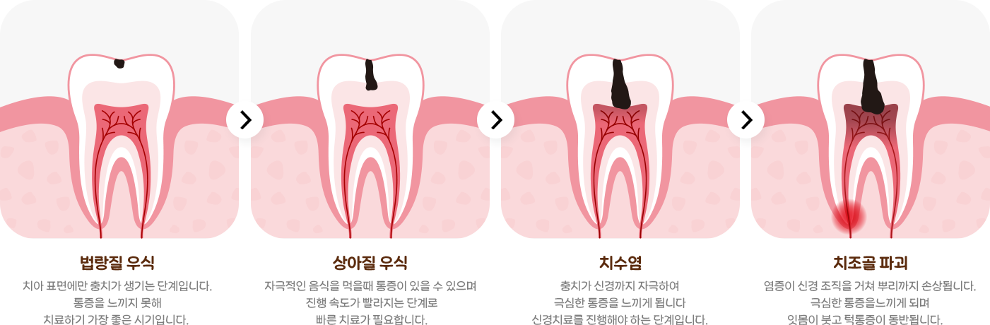 법랑질 우식 = 치아 표면에만 충치가 생기는 단계입니다. 통증을 느끼지 못해 치료하기 가장 좋은 시기 입니다.,
                                    상아질 우식 = 자극적인 음식을 먹을때 통증이 있을 수 있으며 진행속도가 빨라지는 단계로 빠른 치료가 필요합니다.,
                                    치수염 = 충치가 신경까지 자극하여 극심한 통증을 느끼게 됩니다 신경치료를 진행해야 하는 단계입니다.,
                                    치조골파괴 = 염증이 신경 조직을 거쳐 뿌리까지 손상됩니다. 극심한 통증을느끼게 되며 잇몸이 붓고 턱통증을 동반됩니다.> 